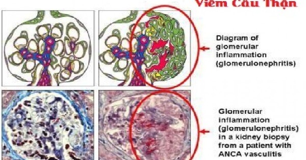 bệnh viêm cầu thận